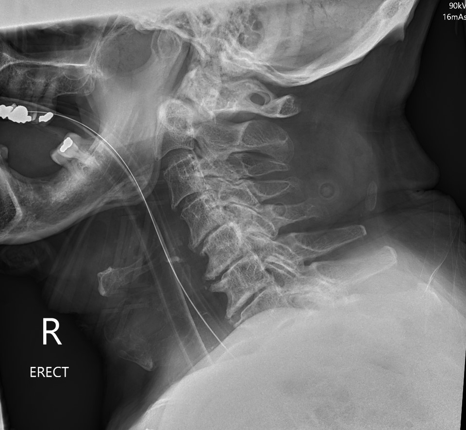 Dens Odontoid Fracture The Bone School 2283